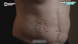 Военнослужащий ВСУ рассказал, кто выжег ему на животе надпись "Слава России"